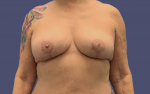 Breast Lift 3 After